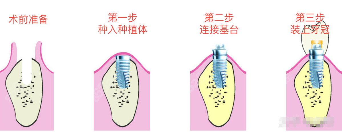 大连拜博口腔种植牙价格表及种植牙步骤