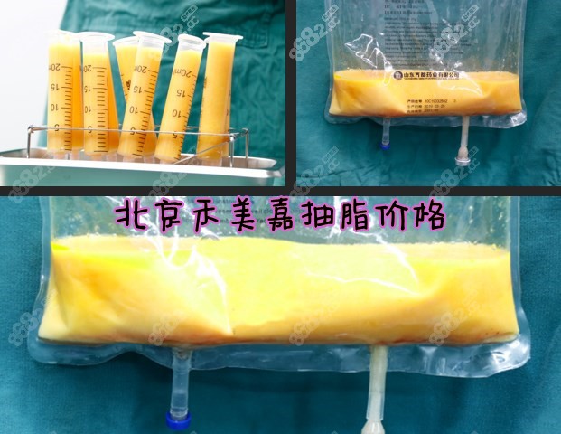 北京禾美嘉抽脂价格是多少8682.cc