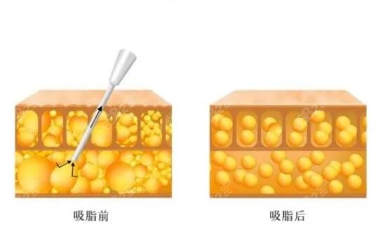 重庆军美医疗美容医院吸脂怎么样m.8682.cc