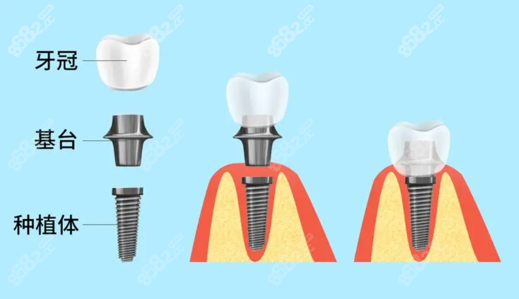 沈阳铁西区做一颗种植牙价格表