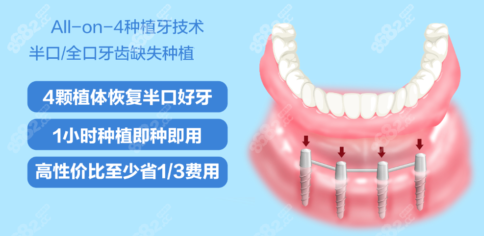 沈阳铁西半口种植牙价格表