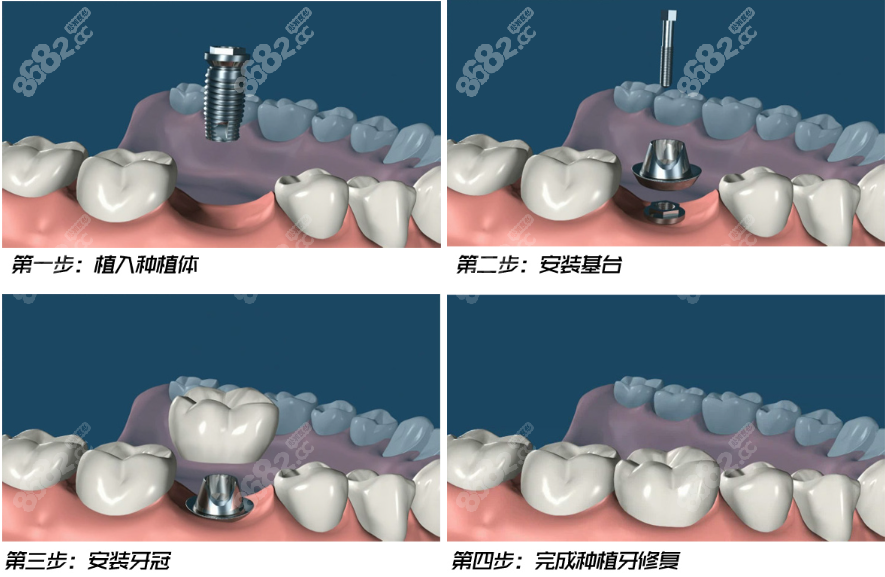 沈阳铁西种植牙过程和步骤