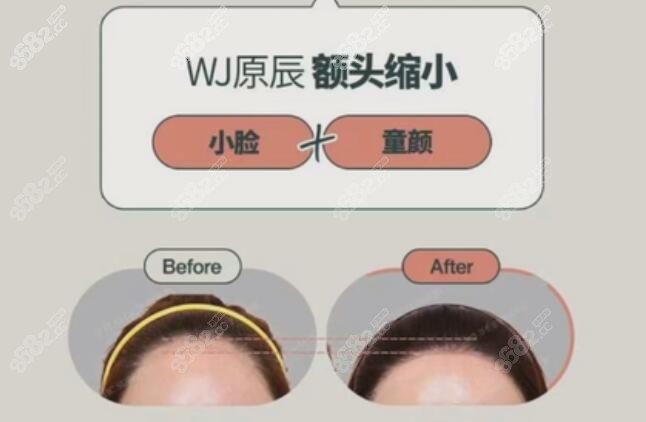 韩国原辰医院额头缩小价格