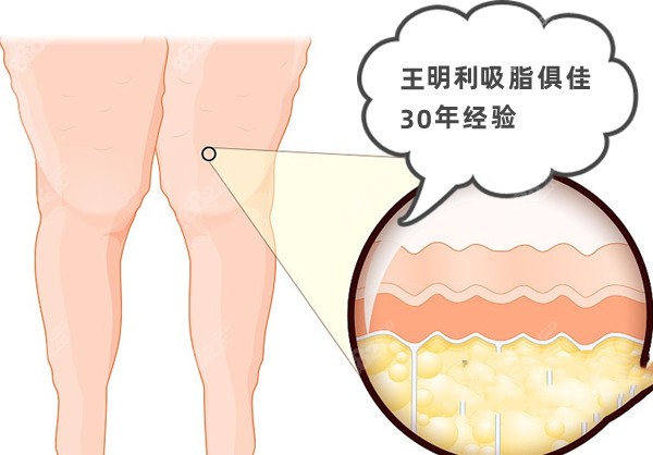 王明利吸脂俱佳30年经验