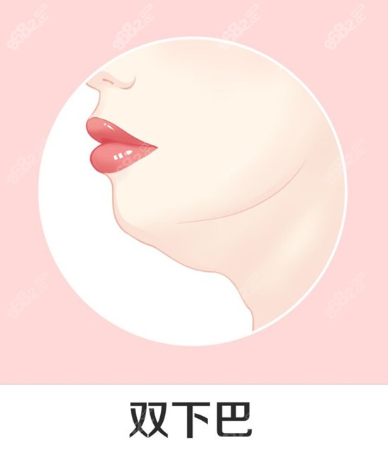 双下巴是做光纤吸脂还是黄金微雕