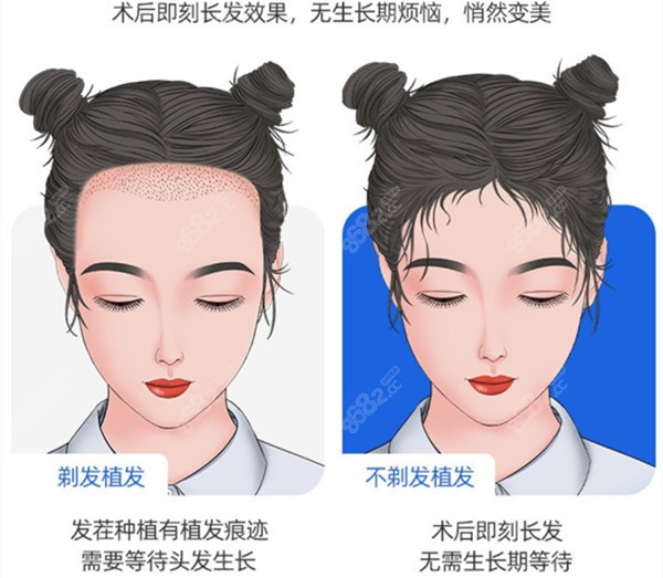不剃发植发不会被人看出