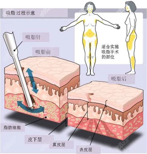光纤吸脂和黄金微雕区别www.8682.cc