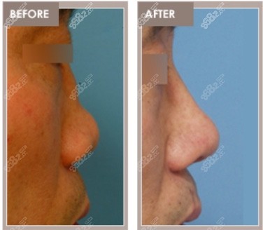 鼻中隔缺失修复手术www.8682.cc