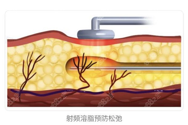 黄金微雕吸脂示意图