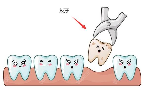 拔牙价格130元起