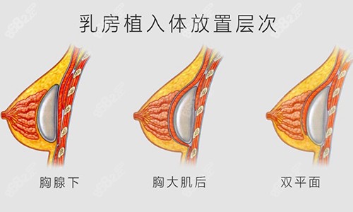 假体丰胸