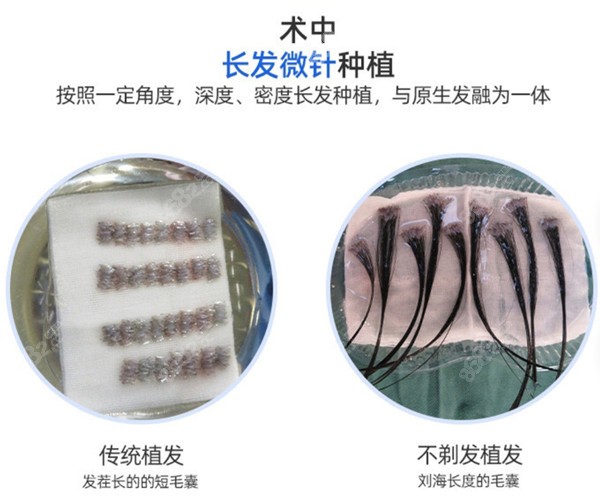长发不剃发植发技术