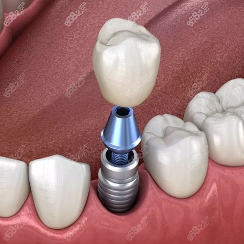 单颗种植牙图示