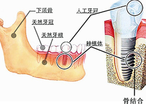 种植牙在牙槽骨内的图