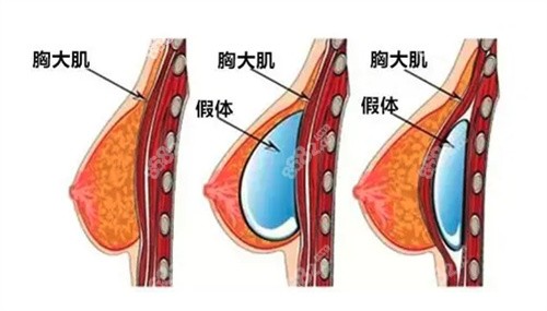 看国内/韩国/泰国男士隆胸医院前十名