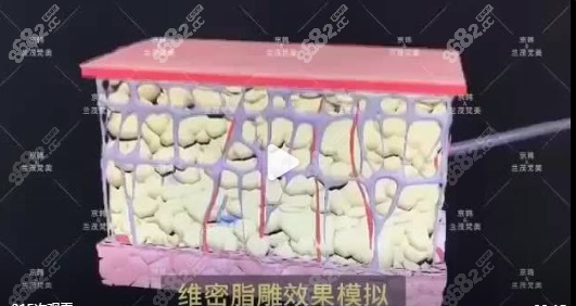 乔爱军脂肪修复过程
