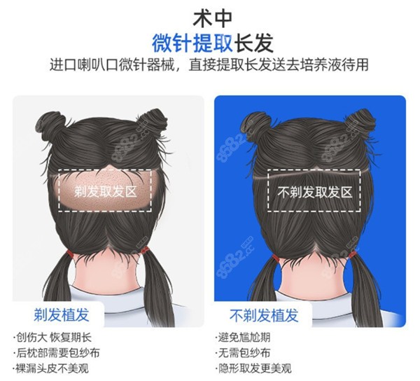 不剃发植发的优势非常大