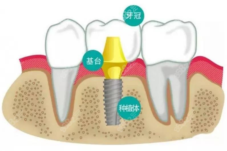 种植牙由三部分组成8682.cc