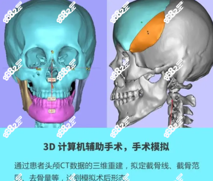 何晋龙3D数字化正颌技术