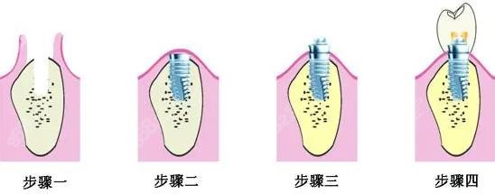 乌鲁木齐美奥口腔种植牙技术靠谱