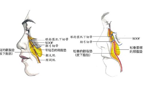 面部提升