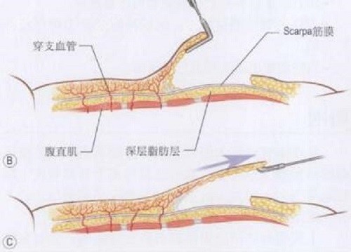 贵州利美康梁安裕腹壁成形术