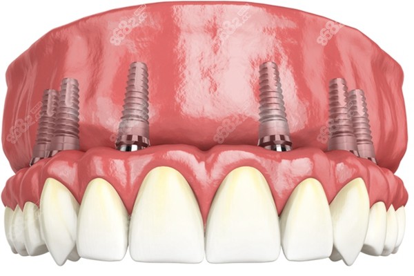 拜博口腔半口种植牙价格 8682网
