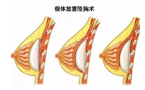 做假体隆胸去广州华美怎么样