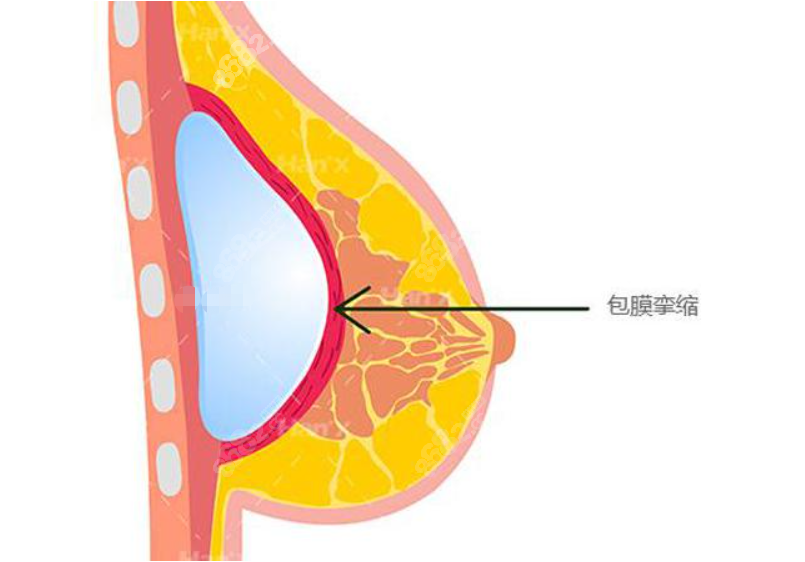 广州朱云医生隆胸包膜挛缩修复价格