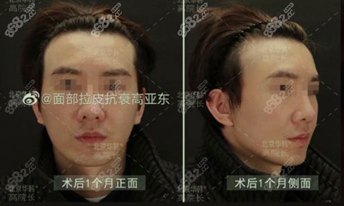 高亚东拉皮手术术后图片