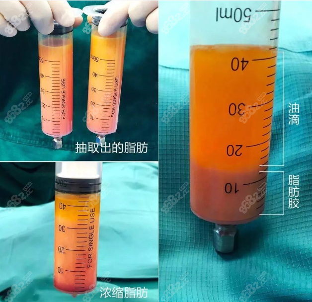 广州朱云医生隆胸包膜挛缩修复怎么样