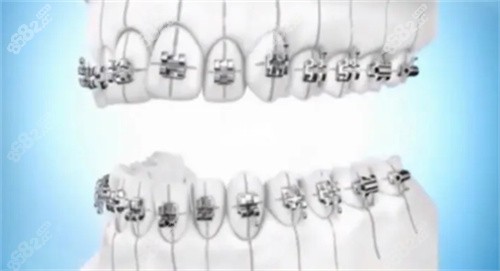 牙齿矫正模拟图