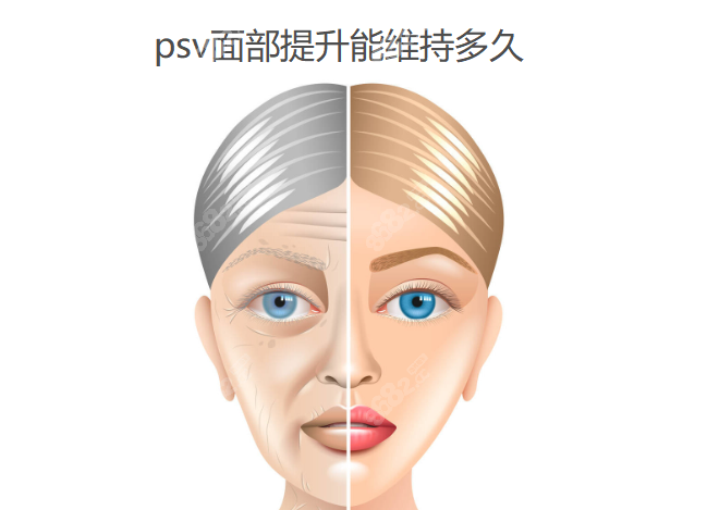 psv面部提升能维持多久