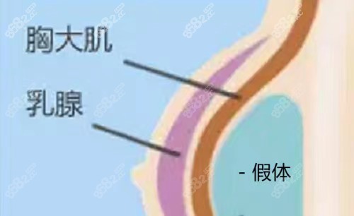 做假体隆胸去广州华美或者是曙光都不错