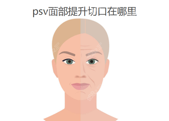 psv面部提升切口在哪里