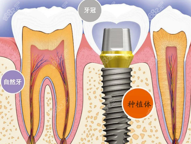 种植牙价格