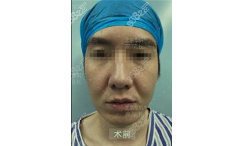 高亚东拉皮手术术前图片