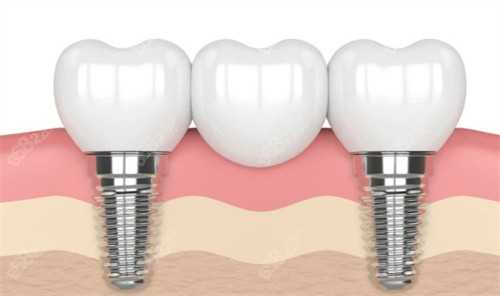 广州私立口腔医院种植牙多少钱?