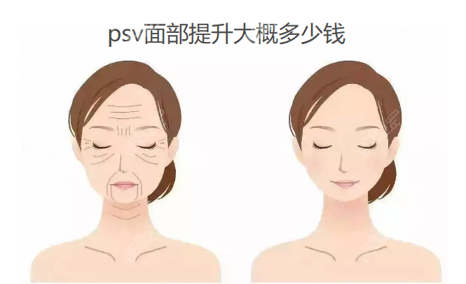 psv面部提升价格www.8682.cc