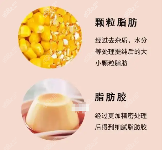 广州朱云自体脂肪胶填充修复胸部包膜挛缩怎么样