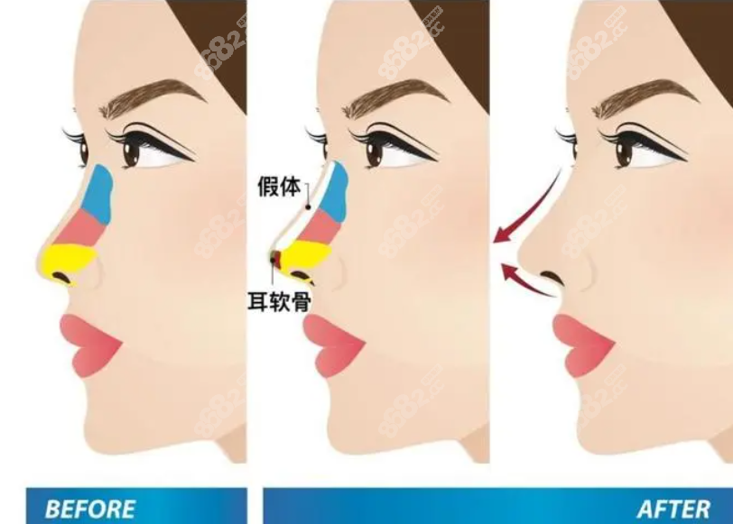 李劲良做鼻子怎么样