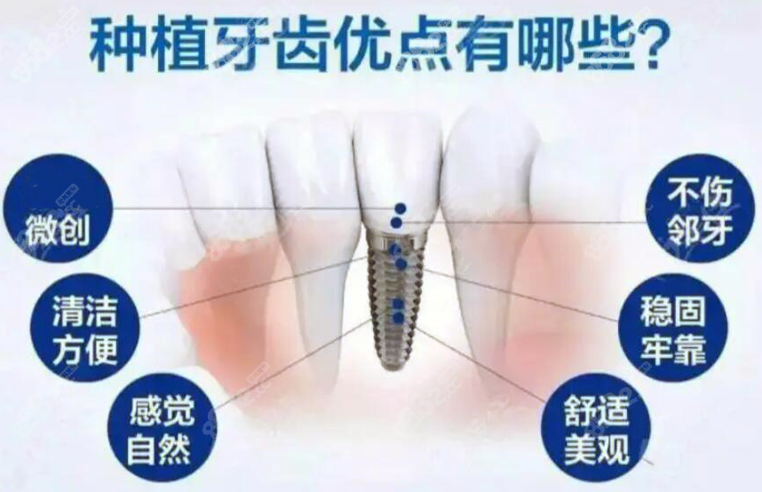 种植牙的优势8682.cc