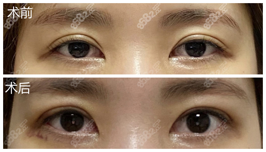 韩国爱护双眼皮修复实例图片真实版