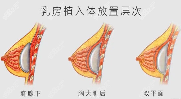 广州中家医朱云隆胸技术特色