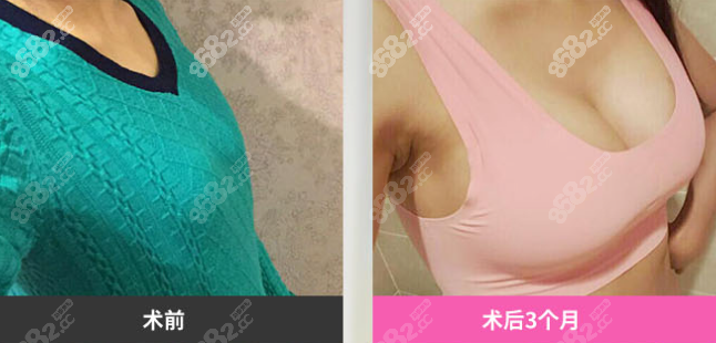 韩国麦恩整形医院隆胸真人对比图