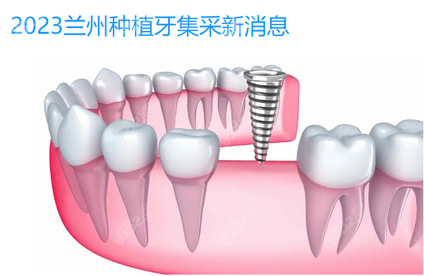 2023兰州种植牙集采新消息