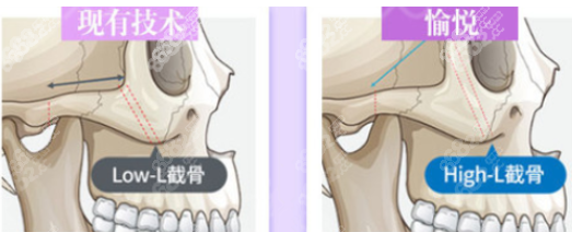 曹弼栋High-L颧骨术8682.cc