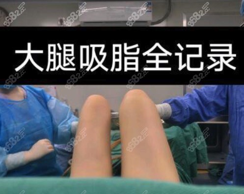 大腿抽脂手术是什么？