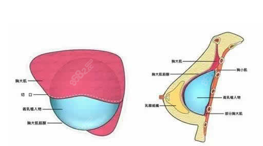 广州有名的隆胸医生排名