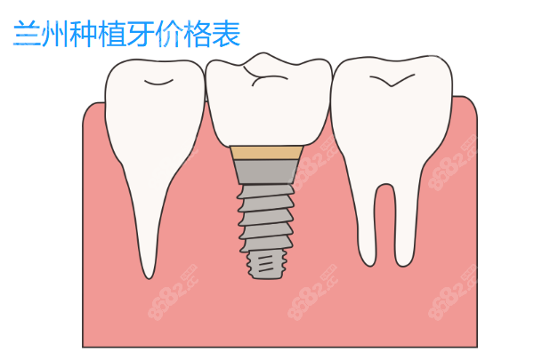 兰州种植牙价格表